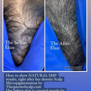 Density SMP works best for clients who:
✔️ Have thinning hair but still have existing hair.
✔️ Want 