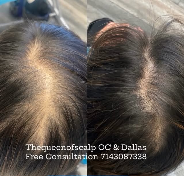 How Density Scalp Micropigmentation (SMP)  Helps-Reduces Scalp Contrast: Tiny, specialized pigment d
