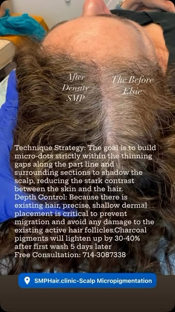 This is density smp by @elsiesooszetojones_smp  #beforeandafter #thequeenofscalp #thinninghairsoluti