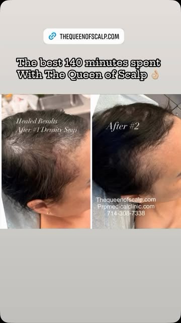 Several sessions required for best results. #beforeandafter #scalpmicropigmentation #hairtattoo #pla