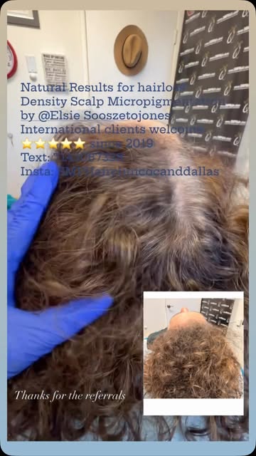 Several common types of hair thinning as per tricology studies are as follows: Androgenetic Alopecia