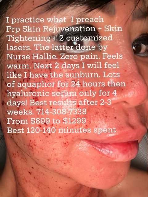 Why You Can Do PRP Skin rejuvenation + Lasers like the Koreans Any Time of the Year?  Unlike strong 