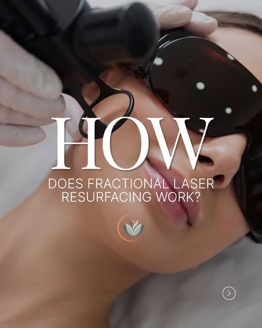 Fractional laser, explained! And right now is the perfect time to start a series. 🍂

✨ Series of 3: