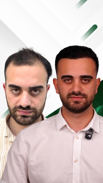 Saçım ekilmiş gibi durmuyor! @kadiryldrmm69 👏

Asıl hedefimiz de tam olarak bu.
Doğal saç çizgisi, 