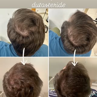 Siempre insistimos en la importancia de tratar el cabello, la cirugía es una opción, pero una entre 