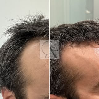 Mejoría de temporales con tratamiento oral @clinicaalbia