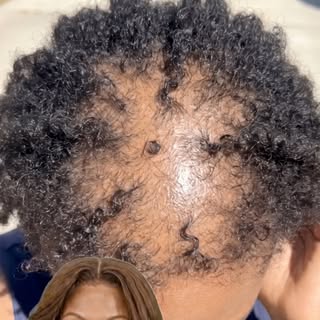 One of the hardest parts of hair loss isn't what everyone else sees.
It's what YOU see.

That moment