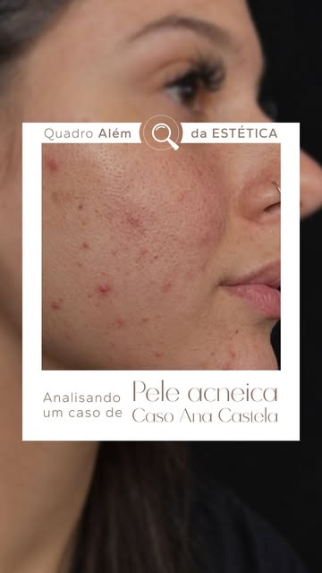 Acne depois dos 25 não é “coisa da adolescência que ficou para trás”. Na mulher adulta, ela pode ter
