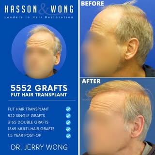 This local patient came to us looking for a major change reconstructing his crown, mid scalp and hai