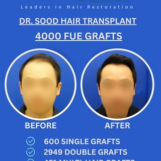 This local patient in his mid-40s was experiencing thinning that extended from the hairline to the c
