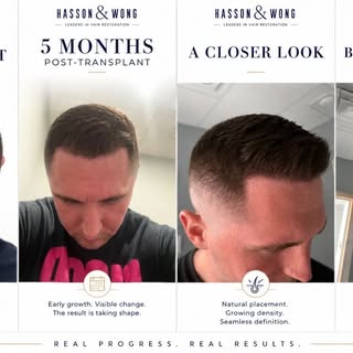 Five Month Progress Progression With Dr. Sood | Hair Transplant Journey

From the initial hairline d