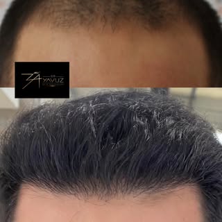 A natural hairline is the key to an undetectable hair transplant.

At Dr. Yavuz Hair Transplant Clin