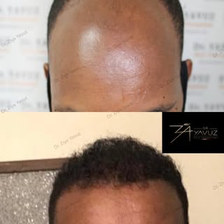 #Hair #Transplant #istanbul #Turkiye #baldness