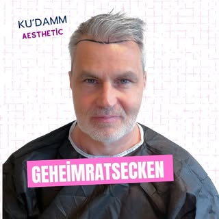 Haartransplantation Geheimratsecken 
Eine erfolgreiche Haartransplantation bei Geheimratsecken stell