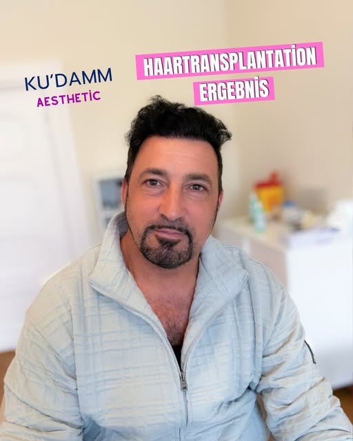 Haartransplantation in Berlin – wie kann ein Ergebnis nach dem Eingriff aussehen?

Bei KU’DAMM AESTH
