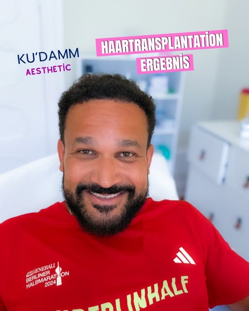 Haartransplantation in Berlin – wie kann ein Ergebnis nach dem Eingriff aussehen?
Bei KU’DAMM AESTHE