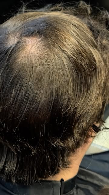 ¿Se puede hacer un injerto de cabello sin tener que raparte? Sí, y este caso lo demuestra 💇‍♂️

Est