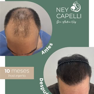 🚨 Si estás perdiendo cabello, deja de esperar. 🚨

La mayoría de las personas que llegan a consulta