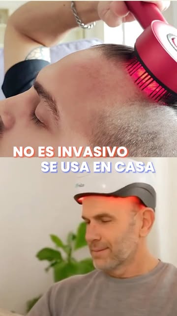 🚨 Lo que está revolucionando la medicina capilar no es un shampoo ni una vitamina.

Hoy existen tra