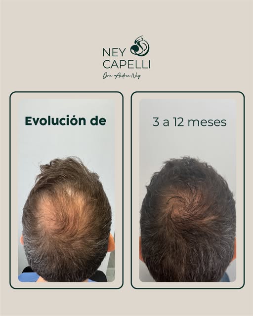 De 3 a 12 meses, cada etapa cuenta. ✨
El cabello trasplantado pasa por un proceso gradual de crecimi