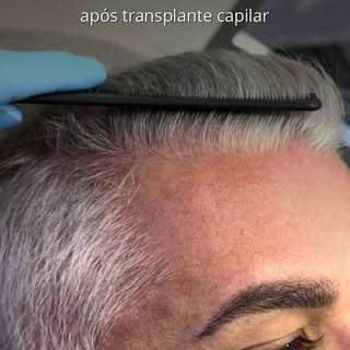 Aqui não existe “cara de transplante”.
Apenas cabelo — como sempre deveria ser.

Resultado parcial a