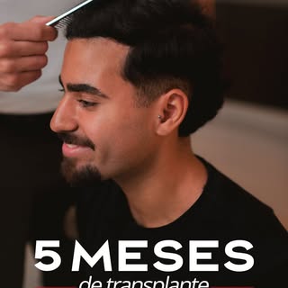 A insegurança de anos ficou para trás. 🙌 pt 1/4
Com apenas 5 meses de transplante capilar, ele já v