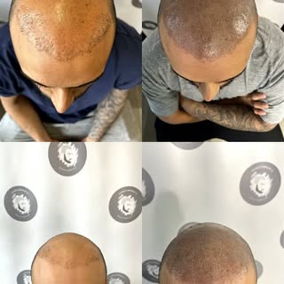 Transformation season line-up. 🔥

The difference a custom hair restoration strategy makes in just a