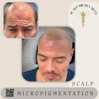 Scalp Micropigmentation with Scalp Micro Arts in Wayne, NJ turns back the clock providing long lasti