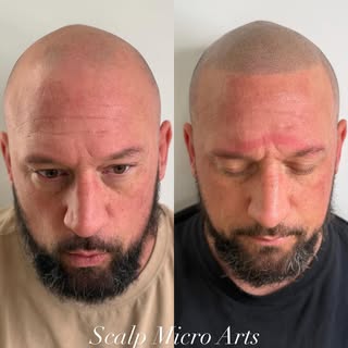 Completely bald… to this.

Not just a look — this is life changing.

Still fresh, a little redness, 