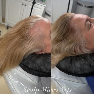 Blonde, brunette, redhead… it doesn’t matter. SMP works for all hair colors.

This client came in lo