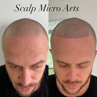 This client came to me five years after having his original Scalp Micropigmentation done by another 