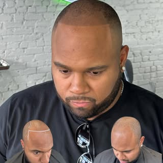 Unlike hair transplants, SMP is non-surgical and requires no incisions or recovery time. This makes 
