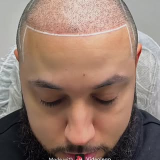Scalp Micropigmentation (SMP) is one of the most effective, low-maintenance solutions for hair loss.