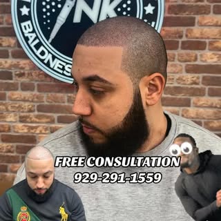 Scalp micropigmentation is a non-surgical hair loss solution that creates the look of natural hair f