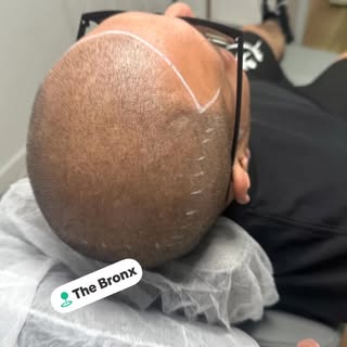 #bald #hairtattoo #micropigmentation #alopecia #barbershop