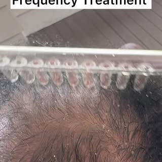 We offer convenient trichology services to help you with your Hair loss issues and scalp disorders. 