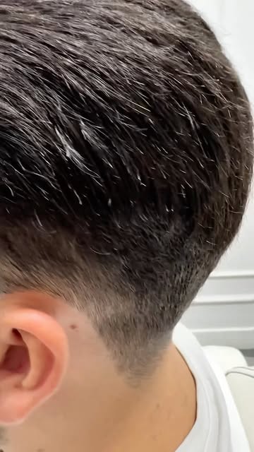 Aynaya bakınca eksik hissettiğin ne varsa, doğru uygulamayla değişebilir.
Erkek protez saç, sadece s