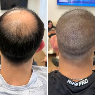 From Augusta to Scalpworx 👊

This client felt like his hair was aging him. He decided to keep a lit