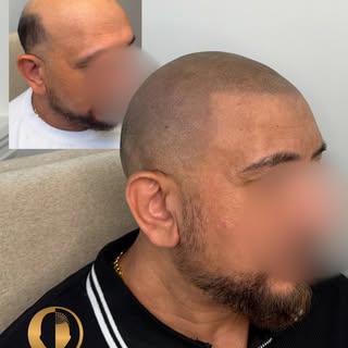 FROM NASHVILLE TO SCALPWORX 

This client traveled from Nashville for his SMP transformation — and t