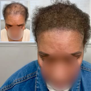 ✨ THE GLOW UP IS REAL ✨

From thinning edges to a full, thriving hairline — this transformation spea