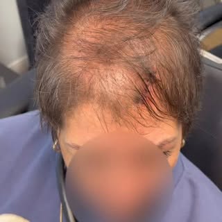 From thin to transformed. ✨

Meet one of our incredible clients who came to us with diffuse thinning