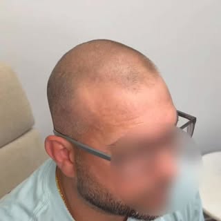He didn’t want a new hairline. He just wanted his hair to look fuller. ✅

That’s exactly what we gav