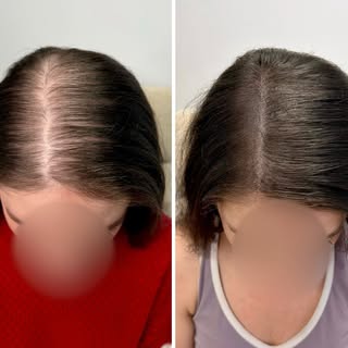 ✨ THREE SESSIONS. ONE INCREDIBLE TRANSFORMATION. ✨

After just three sessions of Female Density Scal