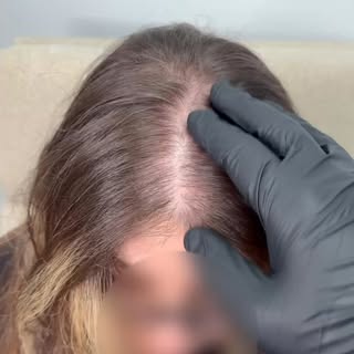 This full-density scalp micropigmentation treatment was designed to create the appearance of fuller,
