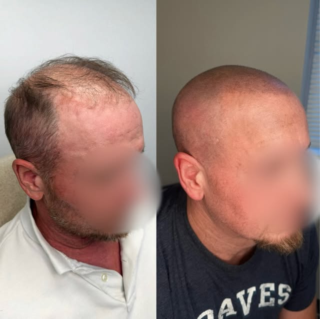 Sometimes adding density isn’t the best answer.

This client came to us after a hair transplant that