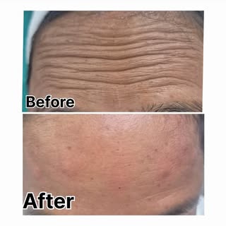 Wrinkles bothering you? It’s time to feel confident again! 
Say hello to a fresher, smoother-looking