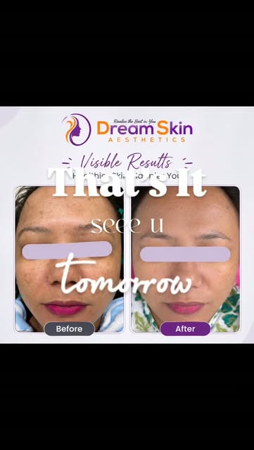 #dreamskinaesthetics #skincare #skincarenepal #dreamskin