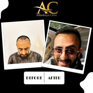 Erhan bey’in 5 aylık sonucu. Sizleride bekleriz.
👩‍🦲➡️🧔🏻‍♂️
☎️+905439736956
.
.
#altunkayaclinic