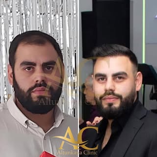 Yusuf bey kaybettiği saçlarına kavuştu. Sıra sizde bizimle iletişime geçin kaybettiğiniz saçlarınıza