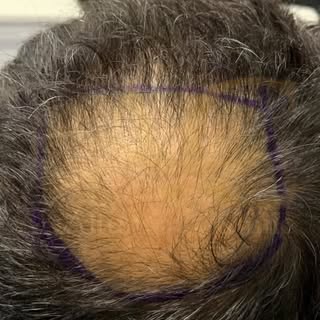 Tepe bölgesinden rahatsız olan Şakir bey, yeni saçlarına kavuştu. Tepe bölgesinde saç çıkmıyor diyen
